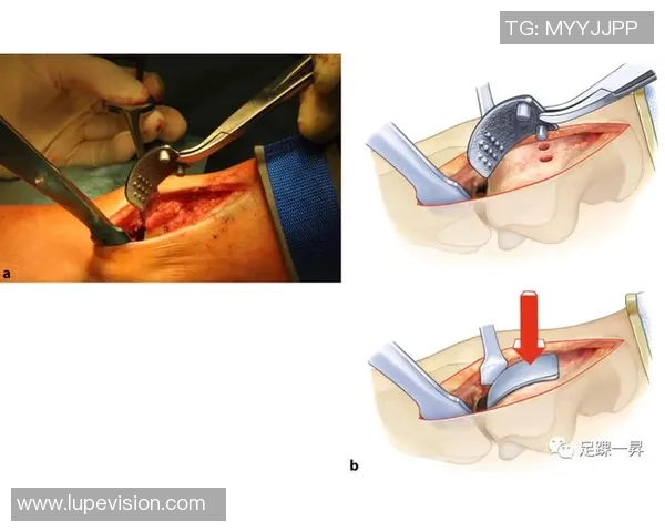 足球明星踝关节置换手术背后的故事与康复之路探秘 足球明星踝关节置换手术背后的故事与康复之路探秘